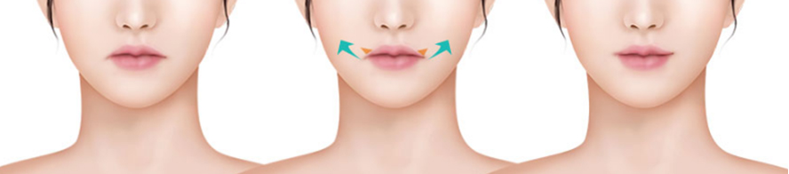 операция по приподниманию опущенных уголков рта